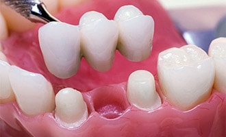 Dental bridge Placement