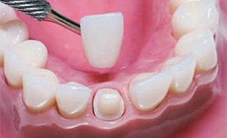 Dental Crown being placed