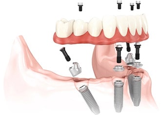 Illustration of lower arch using four implants