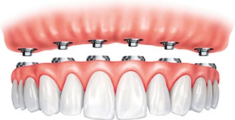 Implant-Supported Fixed-In Dentures in San Jose