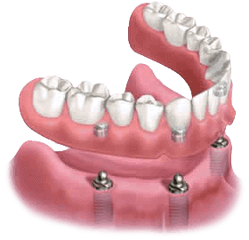 Illustration of snap-in dentures supported by implants