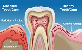 Diagram of root canal