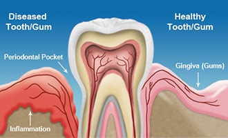 https://d2uvynux30dg3.cloudfront.net/bayareadentalspecialists.com/wp-content/uploads/2017/08/04202039/gum-disease3-200.jpg