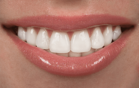 Cosmetic Resin Bonding, Advanced Dentistry