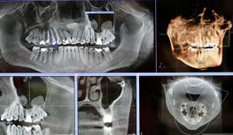 3D State-of-the-art Implant Treatment Planning