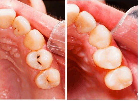 Tooth-Colored Dental Fillings in San Jose