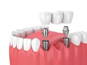 Types of Dental Implants San Jose, CA