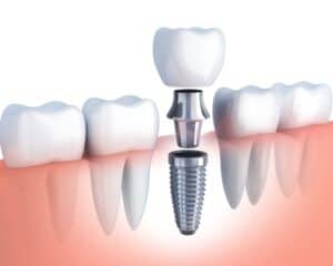 Dental Implant Procedure in Los Gatos, CA