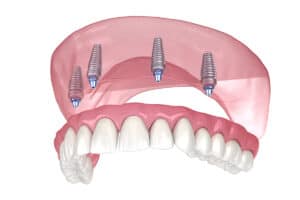 Benefits of Dental Implants for Full Arch Replacement