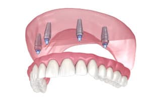 Benefits of Dental Implants for Full Arch Replacement 