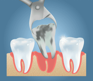 Wisdom tooth extraction San Jose