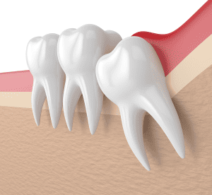 Tooth extraction San Jose