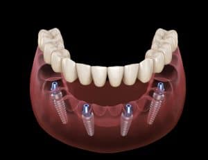 All-on-4 Implant Dentures in San Jose, CA