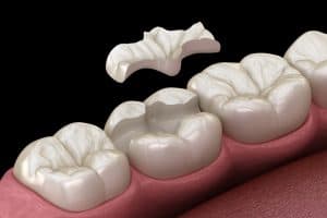Model of a mouth with an onlay hovering over it