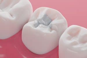 Illustration of a molar tooth cavity with a white filling