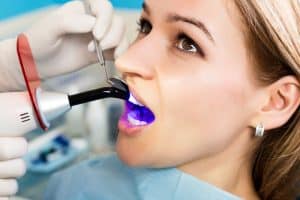 Woman opens her mouth for her dentist to apply dental bonding and a curing light