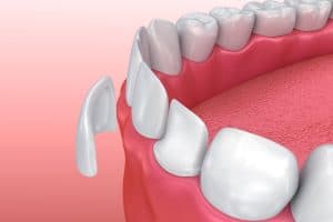 Graphic illustration of a thin veneer being applied to a tooth