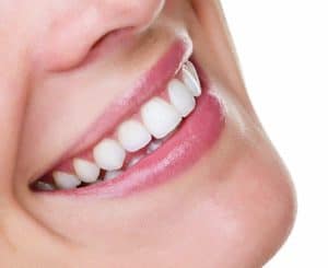 Woman smiles, revealing a beautiful white smile after a teeth whitening treatment for sensitive teeth
