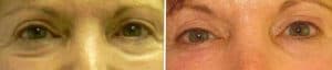 Eyes before and after no scar eyelid surgery to remove eye bags