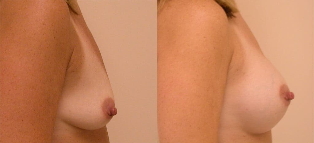 Choose Breast Implant Size in CC Boston