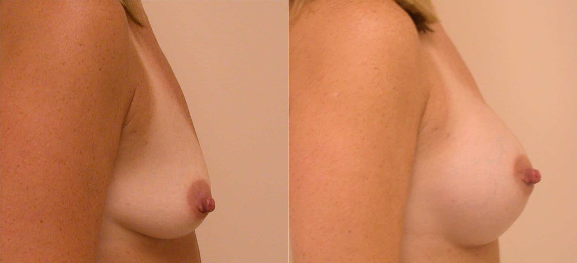 Before and After Keller Funnel Breast Augmentation Boston