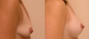 Before & After Breast Implants Boston
