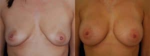 Breast Implant Size Visualizer Boston