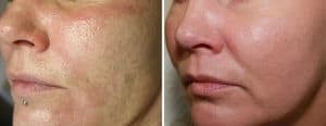 Before and After SecretRF Microneeedling to Improve Skin Texture(Photo Courtesy Zarin Medical)