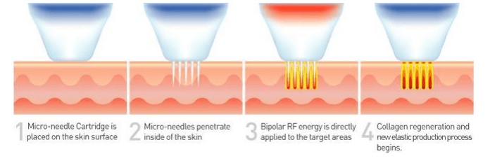Diagram showing how SecretRF Microneedles interact with the skin to promote new collagen formation(Photo Courtesy of Zarin Medical)
