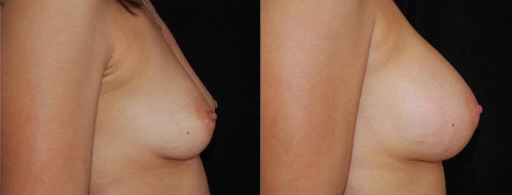 Breast Implant Size Tests Boston