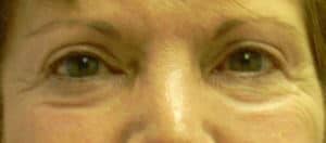 Causes of Dark Circles Under Eyes Boston