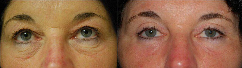 Veins Under Eyes - The Private Clinic of Harley Street