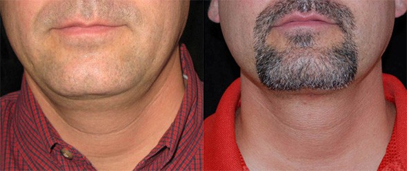 Male Double Chin Removal