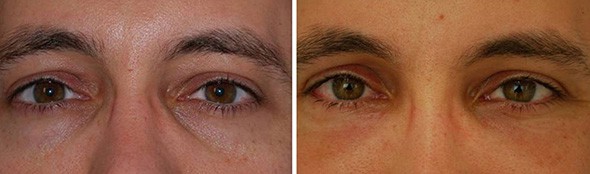 Eyelid Surgery Boston - Blepharoplasty Boston - Eye Lift