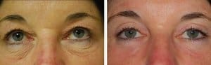 Before And After Laser Eyelid Surgery