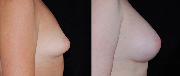 Before and After Tubular Breast Correction Boston
