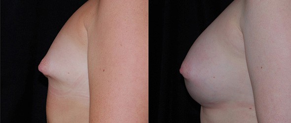 Before and After Breast Deformity Correction Boston