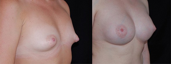 Tubular Breast Correction Boston
