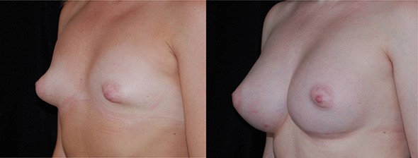 Breast Deformity Correction Boston