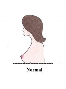 Do I Need a Breast Lift?