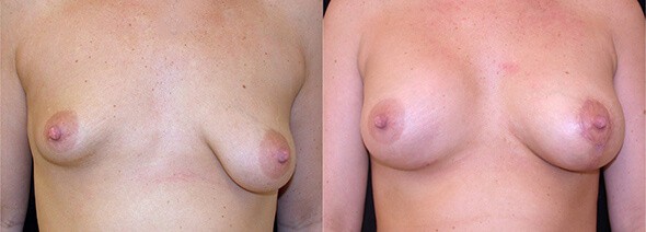 Breast Asymmetry Boston