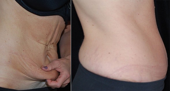 5 Tricks to Help Heal & Fade Tummy Tuck Scars - Boston Plastic Surgery