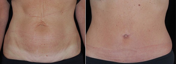 mini tummy tuck scar before and after photos