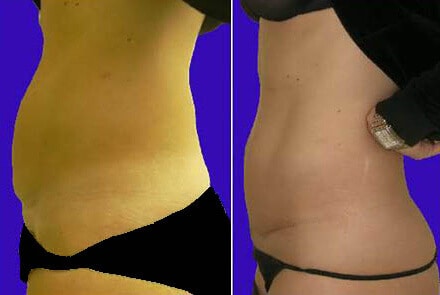 Before and After C-section Scar Removal Boston