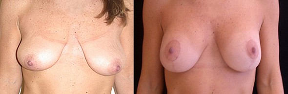 Before and After Breast Lift Boston