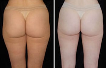Hip Liposuction Boston