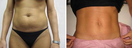 Liposuction Surgery - boston-pss-seckel