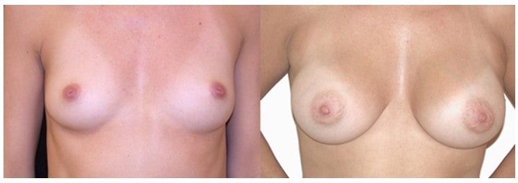 Sub muscular breast augmentation Boston