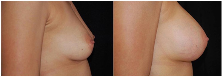 Sub glandular breast augmentation Boston