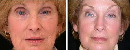 Wrinkle Removal - boston-pss-seckel